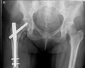 fracture treatment (4)