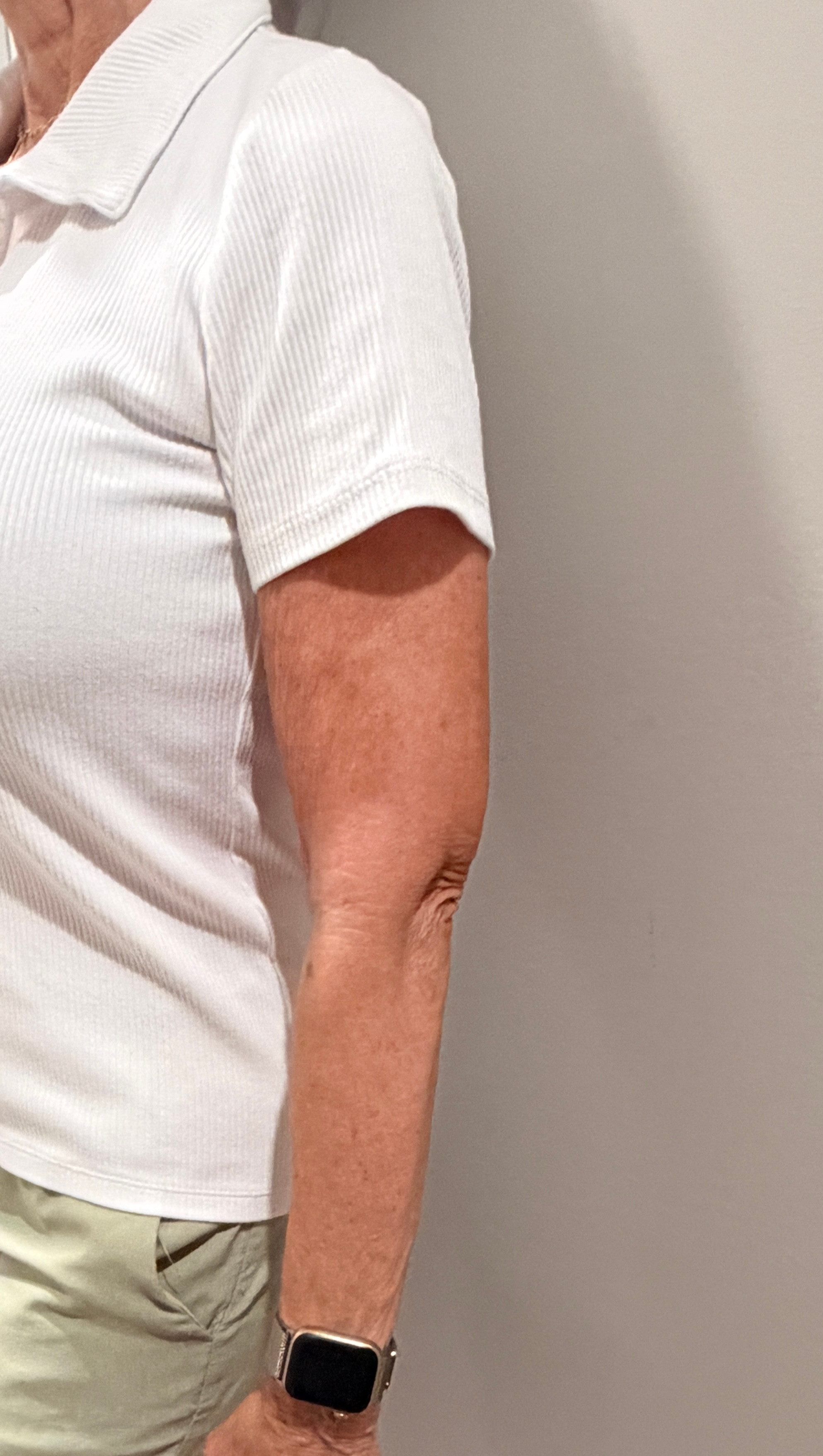 August 2026 (2 months after implementing steps to reduce creepy skin.) Crepey skin is greatly decreased after implementing daily tips to reduce the appearance of daily tips to reduce crepiness.
