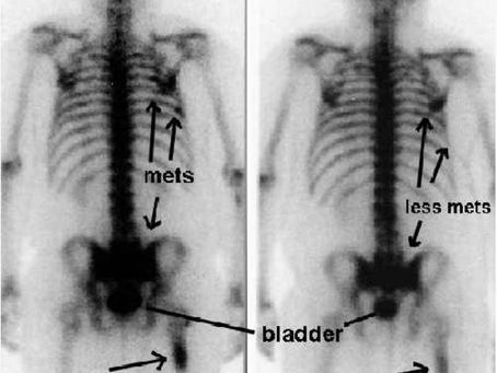 乳癌 case 4 骨に転移