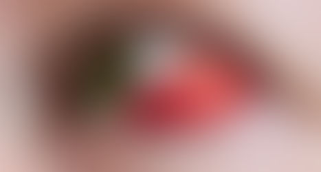 結膜下出血