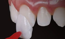 faceta-de-resina-ou-lente-de-contato-dental-diferença-qual-é-melhor