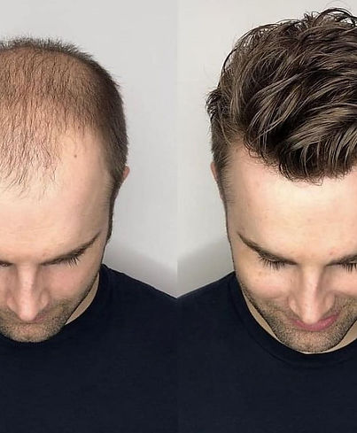 Men's Hair Replacement System Giving You a Better Look _Men��‘s Wig for Hair Loss.jpg
