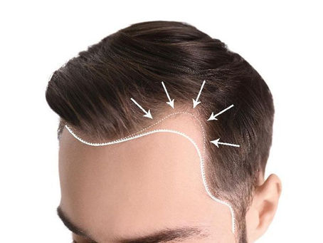 Hair Transplant in Turkey: What International Patients Should Expect