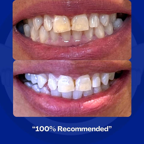 teeth white improvement