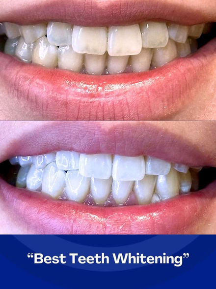 teeth white improvement