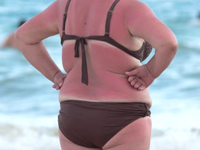 Why can't I get a massage if I have a sunburn?