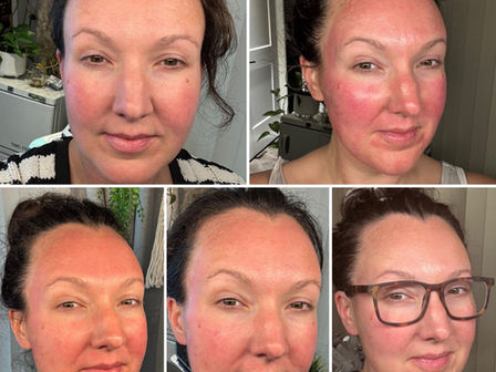 Microneedling in Langley, BC (Brookswood): What It Helps + What to Expect.