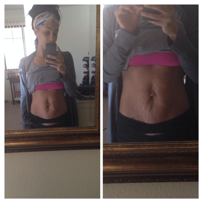 The Truth About Stretch Marks