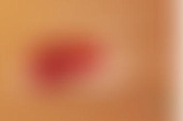 Fatty Liver Disease Symptoms: Signs of Liver Damage from Excess Alcohol Intake