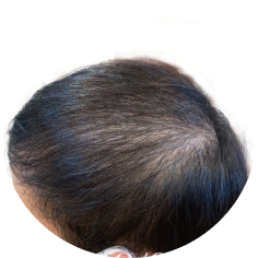 ビフォー薄毛の頭部、髪質改善画像02