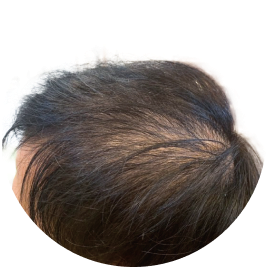 ビフォー薄毛の頭部画像01