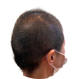 アフター薄毛の男性の後頭部画像