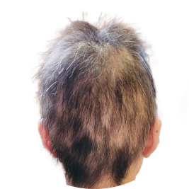 アフター薄毛の頭部、後ろ姿画像