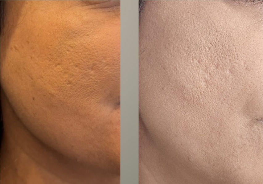 Acne Subcision