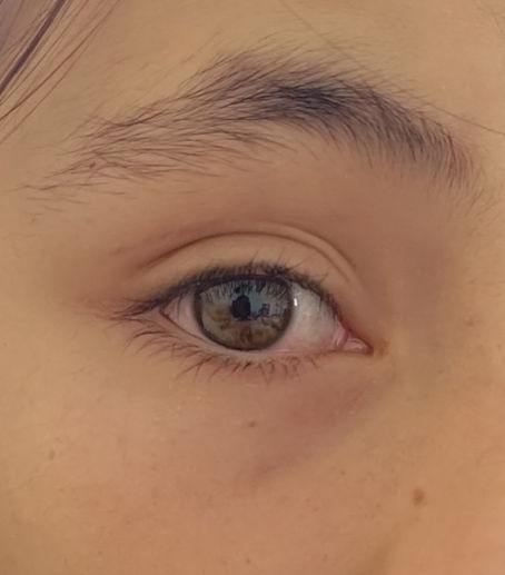 THE EYE INCIDENT!