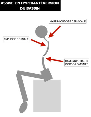 Schéma hyperantéversion cambrure excessive instabilité posturale