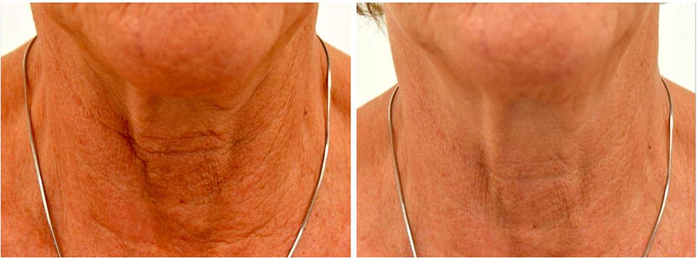 turkey neck before and after exion petoskey michigan reyouvenate