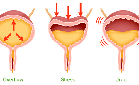 Bladder Leaks Aren’t Normal—They’re Common: Here’s How to Fix Them Without Surgery in Petoskey