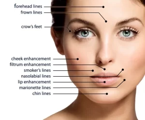 Persona-Medical-Dermal-Fillers-300x249.webp