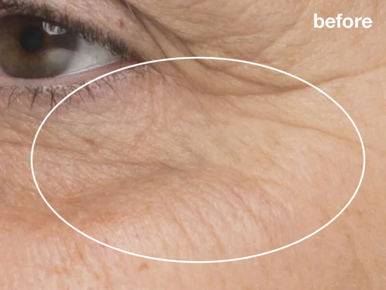 services-pro-power-peel-before-3b.webp