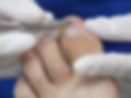 Orthonyx Bracket, toenail clamp, the Pod