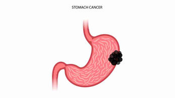Zolbetuximab: a drug that could help treat gastric cancer! 