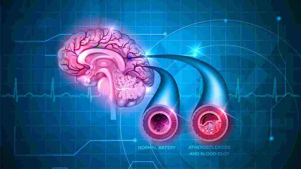 Vascular dementia