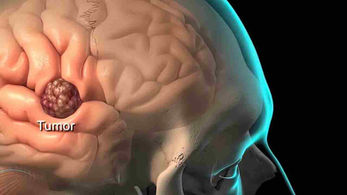 An overview of Meningioma