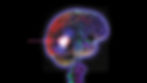 Meningioma