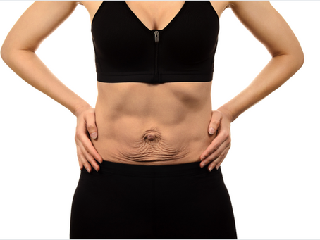 What Is Diastasis Recti Abdominal Muscle Separation And What To Do About It