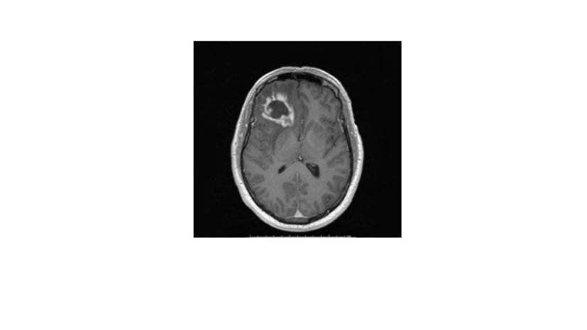 Slice of a brain with glioblastoma