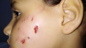 Perro ataca a menor de edad dejándole múltiples heridas en el rostro