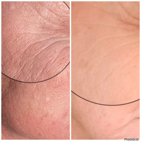 Procell results one session fine lines reduced after 3 weeks micro channeling Towanda Pennsylvania