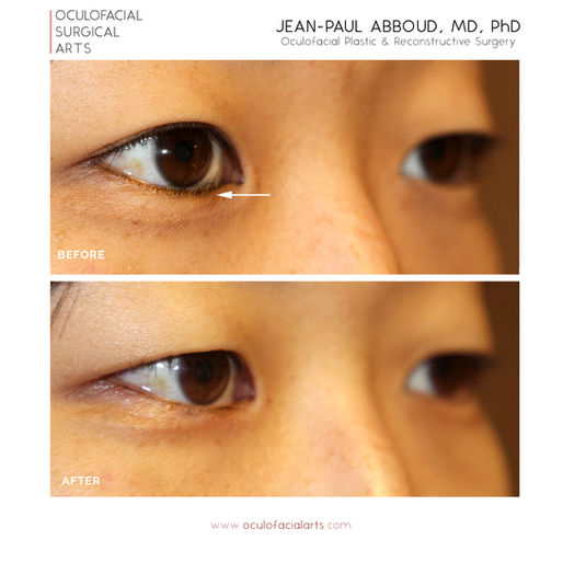 What is an Epiblepharon? And how do I Repair Them?