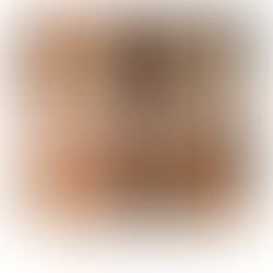 What is a Chalazion?