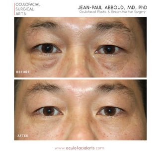 Male Lower Eyelid Blepharoplasty with Fat Redraping