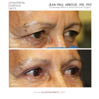 Before and After Upper Blepharoplasty and Browpexy