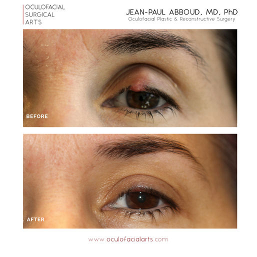 How to Treat a Stye: Incision and Drainage of a Chalazion