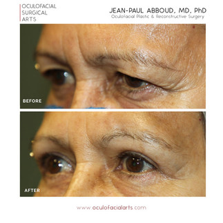 Before and After Upper Blepharoplasty and Browpexy