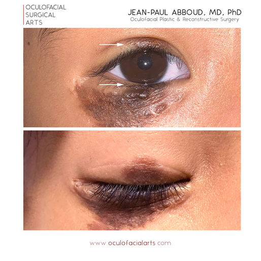 What is a Kissing Nevus of the Eyelids?