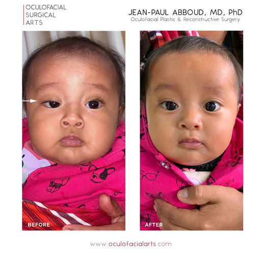 What is Congenital Ptosis (Eyelid Droop)?