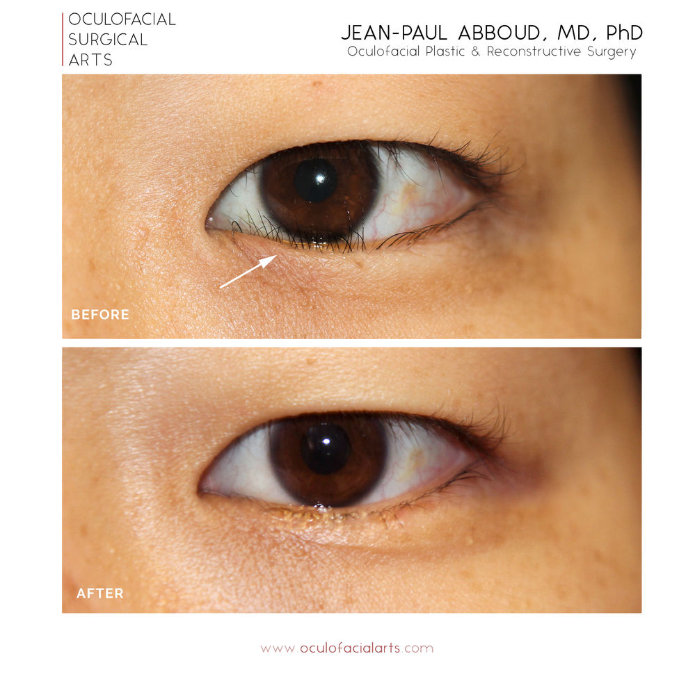 What is an Epiblepharon? And how do I Repair Them?