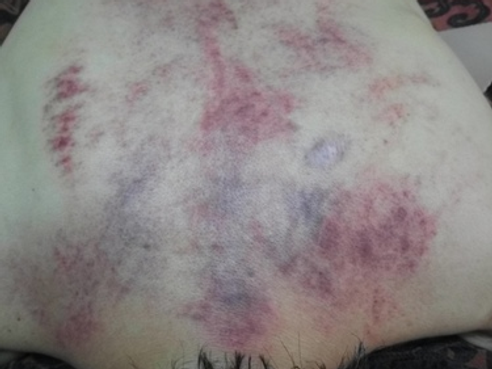 臨床個案[卅十]- 帶狀皰疹(生蛇)神經痛後遺症