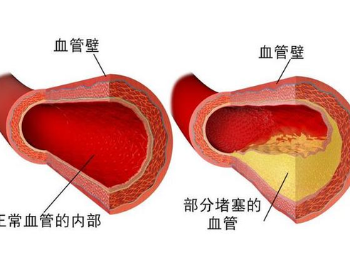 動脈硬化是心梗腦中風先兆 8種易患人群