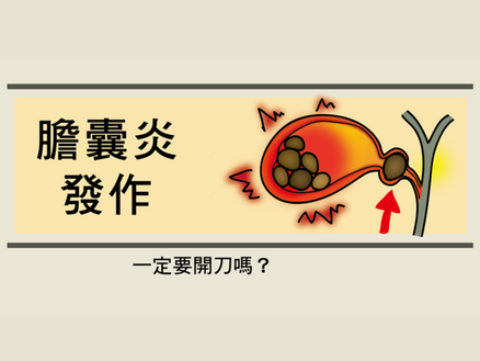 膽結石初期不一定要切除膽囊