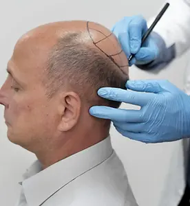 fue-hair-transplant-before-and-after-3-2048x1366.webp