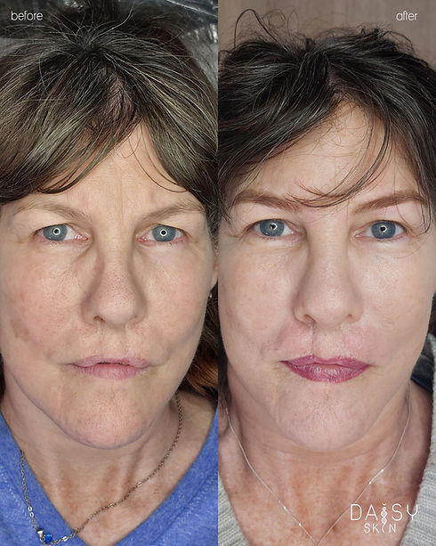 lip tattoo by daisy skin after cleft palate surgery