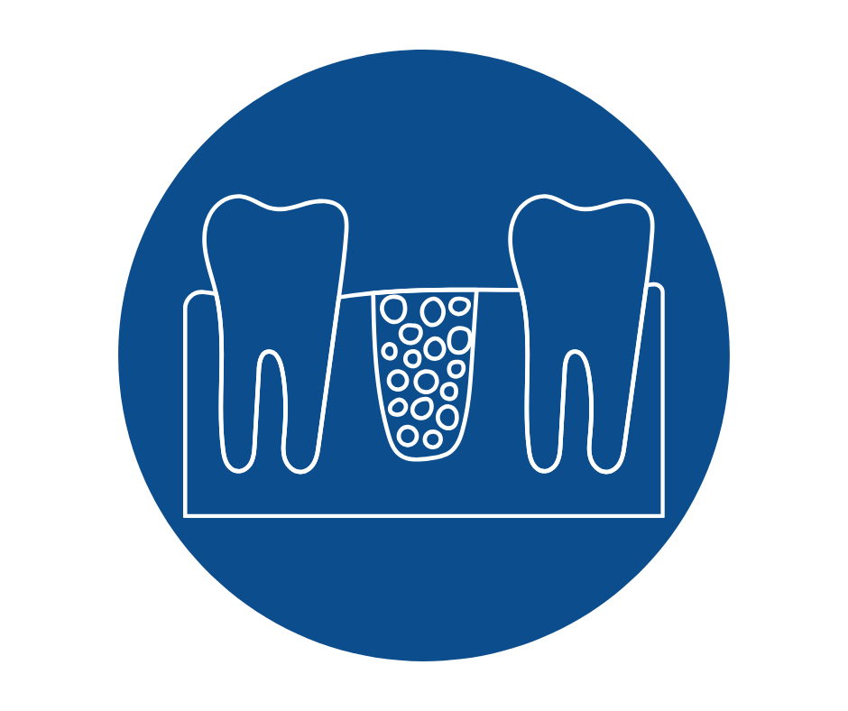 bone grafting.png