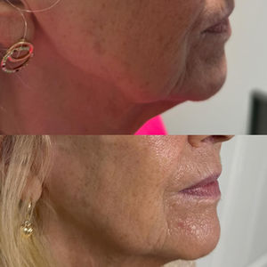 Facial Profile and Skin Elasticity