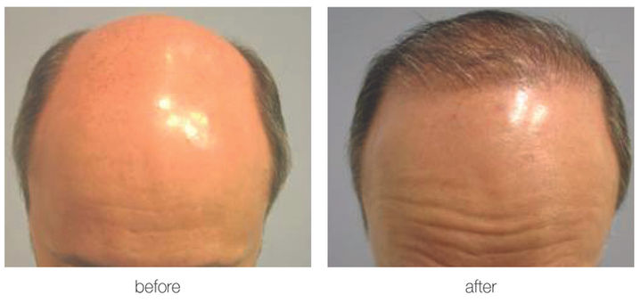 Hair Transplant | Aliestetic